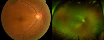 Tzuyang's battle with retinal pigment degeneration, causing blindness...What are the symptoms and treatments?