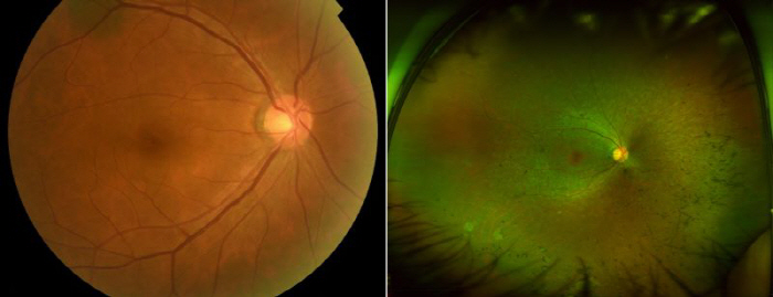 Tzuyang's battle with retinal pigment degeneration, causing blindness...What are the symptoms and treatments?