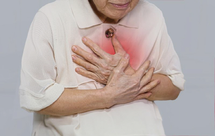 Overeating during the Chuseok holiday, Watch out for reflux esophagitis...Help with a 30-minute walk after meals