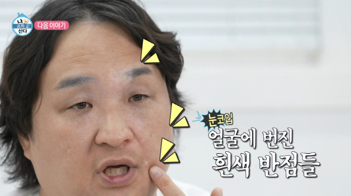 Koo Sung-hwan was worried about vitiligo, but he was sad about the recent situation. White spots with smudged eyes, nose, and mouth (Na Hon-san)