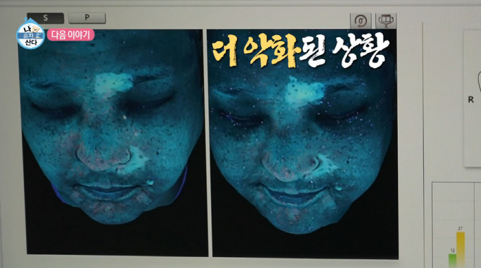 Koo Sung-hwan was worried about vitiligo, but he was sad about the recent situation. White spots with smudged eyes, nose, and mouth (Na Hon-san)