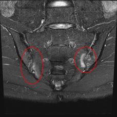 I thought it was a herniated disc... Stiff spinal cord stiffening ankylosing spondylitis, treatment?