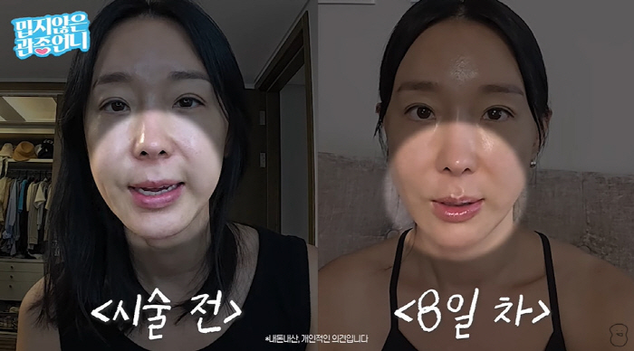 46-year-old Lee Ji-hye confesses that thread lifting  lip tattoos became clear and decided on the procedure (Gwan Jong-un's sister)