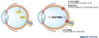 Suddenly, it's dark in front of me...high myopia, a red flag for retinal health