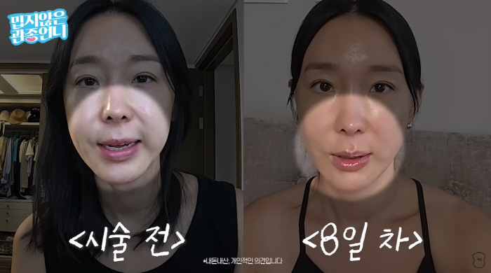 Lee Ji-hye, 45, changed her face after thread lifting♥ Moon Jaewan has become so pretty
