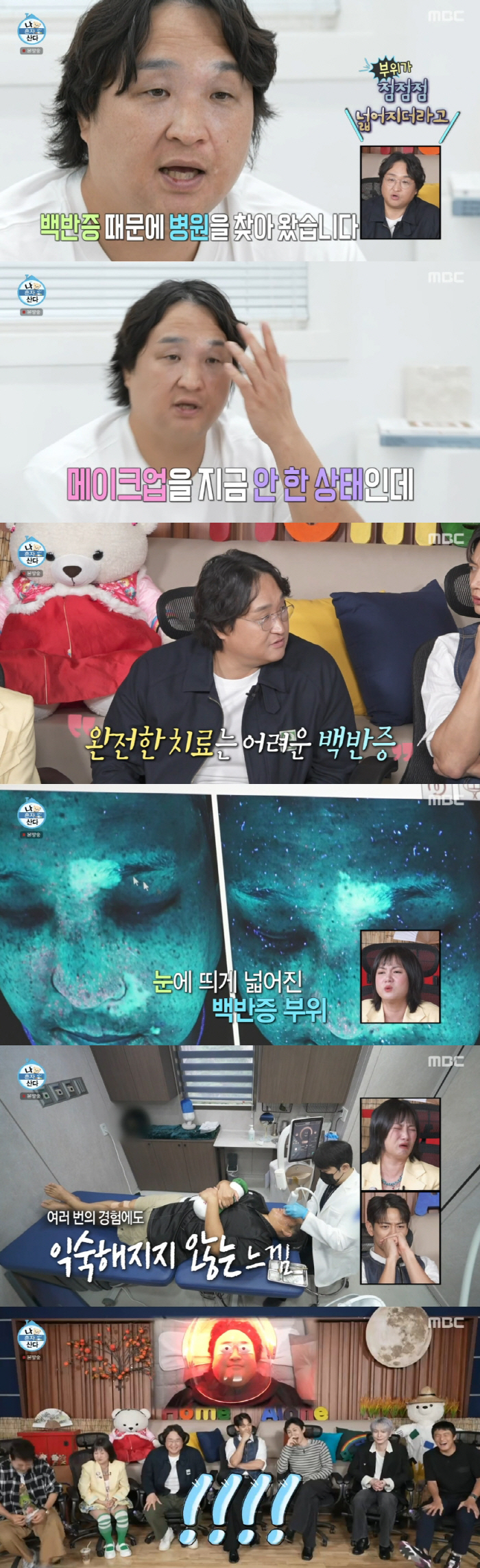 Sung Kyu-hwan, the vitiligo area is getting wider and serious..My hair is all white