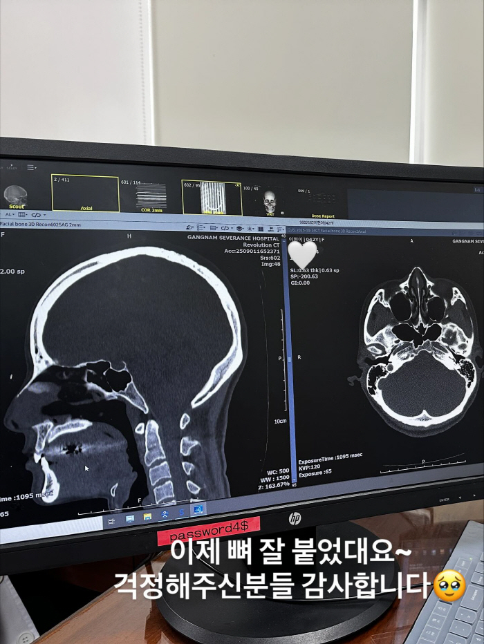 Lee Hyun-yi Reveals Nose Surgery Live...I'm back to my old nose