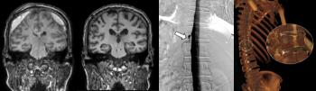Severance Hospital's first successful diagnosis and treatment of cerebrospinal fluid venous fistula...All four patients with brain haemorrhages who couldn't find the cause recovered