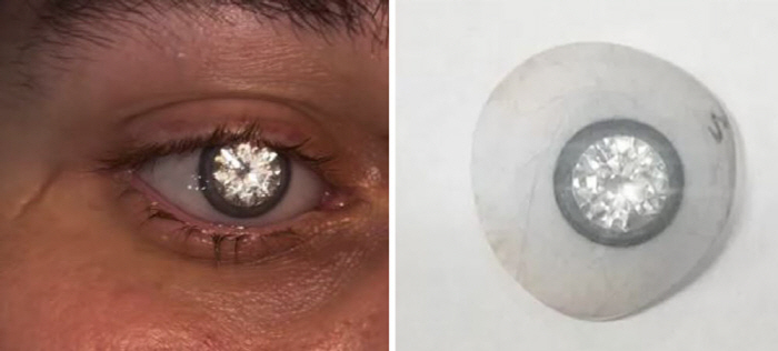 I lost one eye and made a 2-carat diamond bill...A new light in my life
