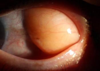 A visible yellow bump, ocular fat escape, and care for the elderly