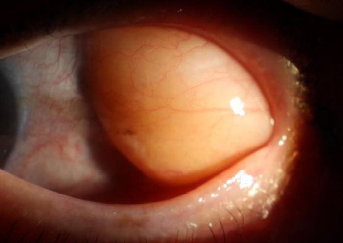 A visible yellow bump, ocular fat escape, and care for the elderly
