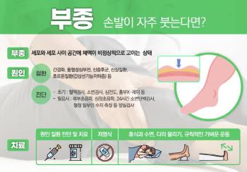 I wondered why my hands and feet get swollen often, because of this?