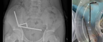 A 13-year-old boy who swallowed 100 super-powerful magnets almost lost his life...Buy from Temu despite sale ban