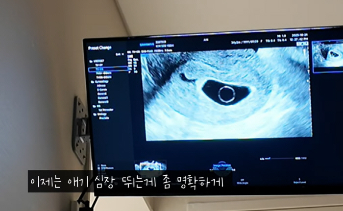 'Baby's heart is not beating'...Robin ♥ Kim Seo-yeon's miraculous pregnancy is just 2 weeks old. Sad tears (Rod couple)
