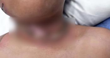 Nine-year-old heavy wound due to necklace electrocution accident while charging tablet...I almost lost my life