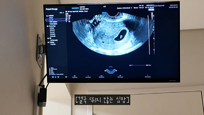 Robin ♥ Kim Seo-yeon's sobbing heart did not beat after a mooring miscarriage surgery (Rod couple)