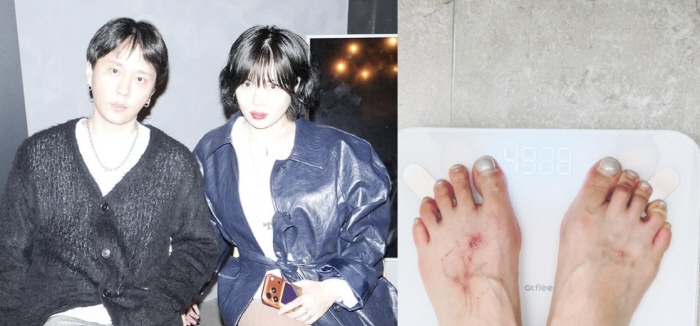 Just one month, 10kg Hyuna, ♥ Yong Junhyung and Kkong-nyang...A clear tattoo scar on the top of the foot 