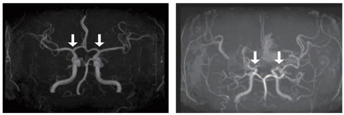 Discovery of Prediction Indicators for Diagnosing and Prediction of Childhood Moyamoya Disease...Expectations to present new treatments