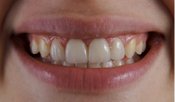 It's no use brushing your teeth?5 Foods to Make Yellow Teeth