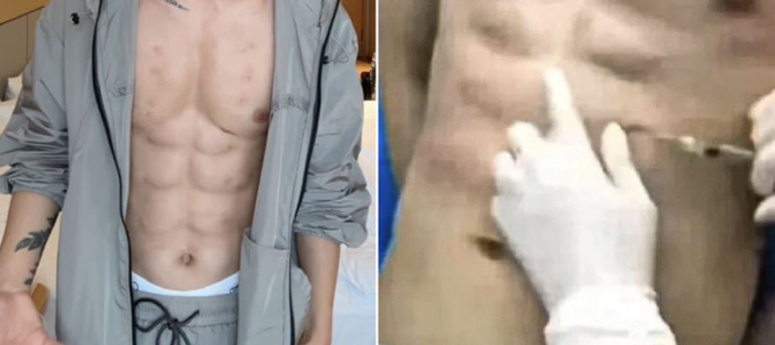 A man who spent 800 million won on 8 pack abs...20% of the body is hyaluronic acid