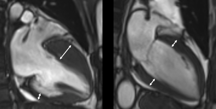 Dangers of sudden death Quiet hypertrophic cardiomyopathy, how do you handle it normally?