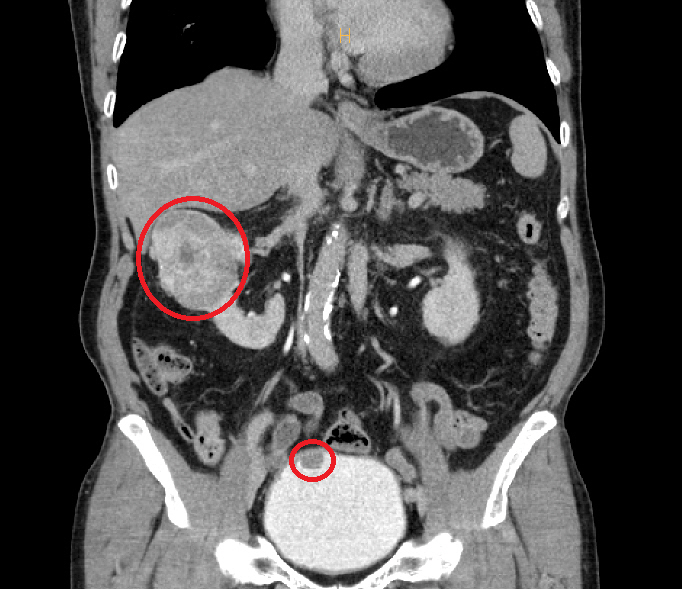 Soonchunhyang University Bucheon Hospital succeeded in simultaneously performing 7cm kidney cancer robot partial resection and bladder cancer endoscopy
