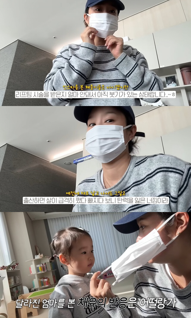 Heiseni, due to swelling of the face lifting procedure after giving birth to the second child