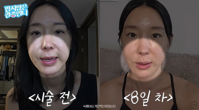 Lee Ji-hye, make someone else look different after the thread lifting procedure