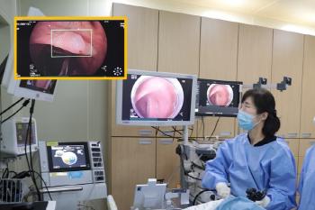 AI-assisted colonoscopy finds 32% more adenomas
