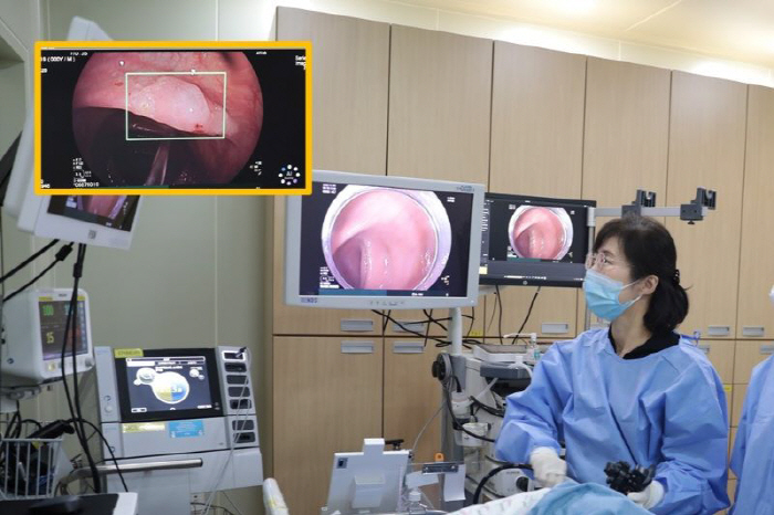 AI-assisted colonoscopy finds 32% more adenomas