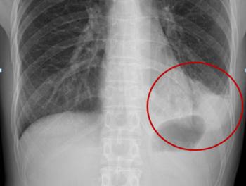 In-between seasons and winter pneumonia watch...Fatal vaccination for the elderly is important