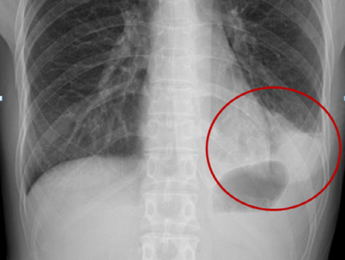 In-between seasons and winter pneumonia watch...Fatal vaccination for the elderly is important