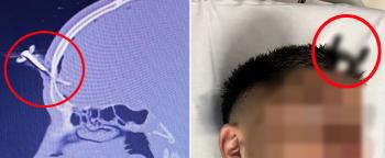 My daughter got involved in violence during a soccer game, and I got my car key stuck in my dad's head