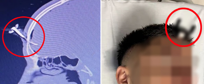 My daughter got involved in violence during a soccer game, and I got my car key stuck in my dad's head