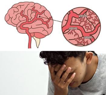 Suspected Moyamoya disease in children, 30s, and 40s with repeated headaches and paralysis of the arms