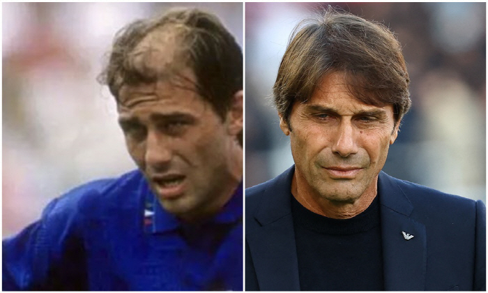 Tottenham's hair loss line is full of confidence! First-ever partnership agreement with the world's largest Turkiye hair transplant clinic