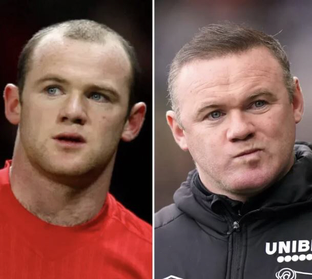 Tottenham's hair loss line is full of confidence! First-ever partnership agreement with the world's largest Turkiye hair transplant clinic