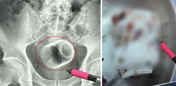 Constipation male found 8cm cup in anus for 3 days...It was an accident. An excuse