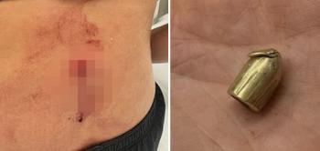 Beauty volleyball star is shot in the back by a robber...be reborn alive by a few millimeters