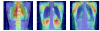 Development of an AI model that can predict osteoporosis status with chest X-rays
