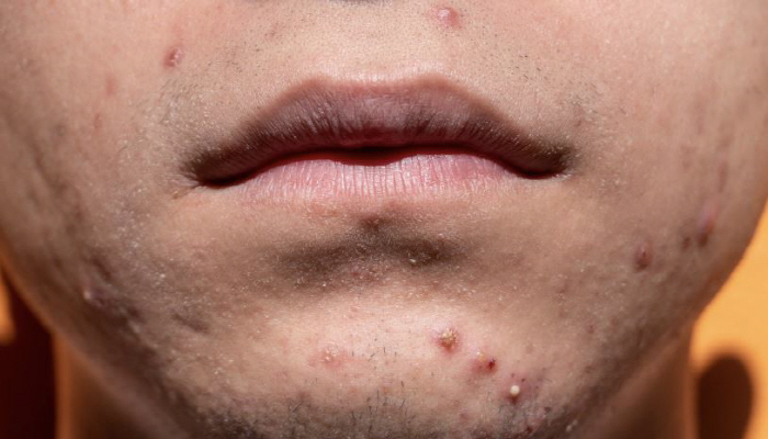 I just got a pimple, but now that I know why I'm getting lung disease...