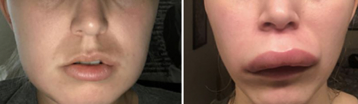 Do you know of hereditary angioedema, which takes an average of 8 years to diagnose?