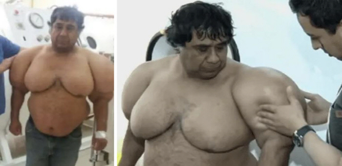 A man with a balloon-like body, suffering for 12 years...It's a miracle to be alive