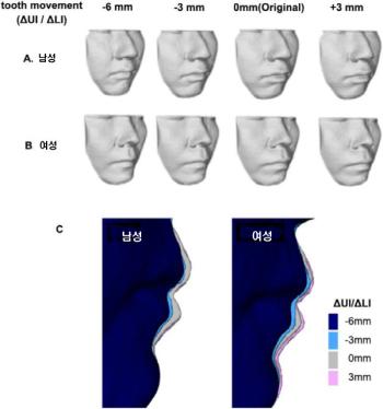 Adult orthodontics satisfaction is higher in men than in women