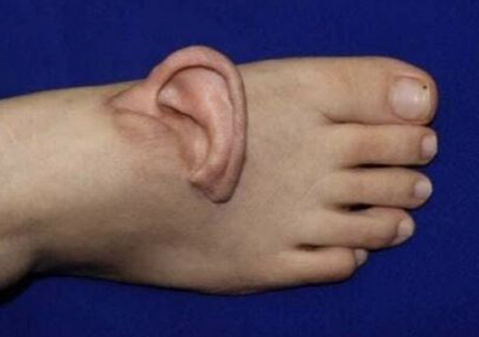 Oh, why are my ears on the top of my foot?Incubated for 5 months, transplanted